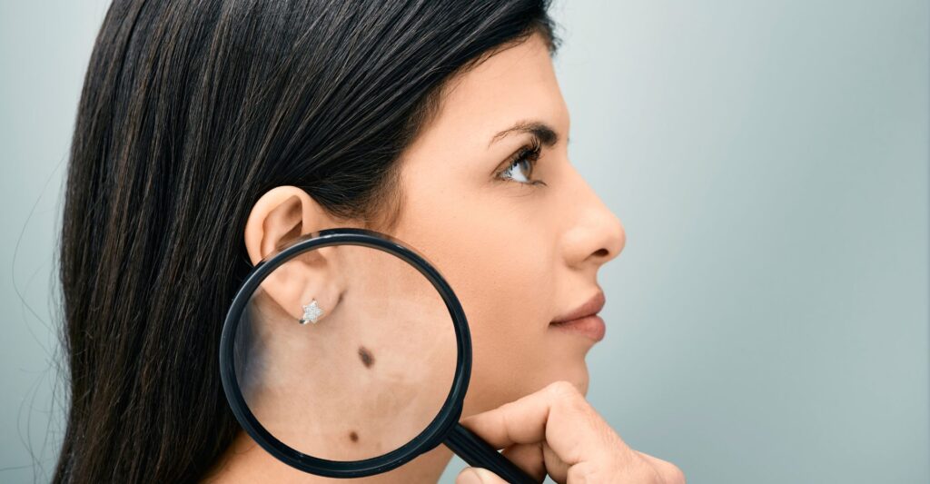 woman with moles on neck magnifying glass