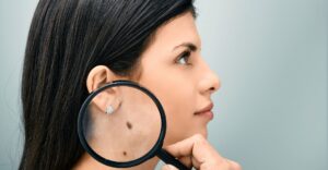 woman with moles on neck magnifying glass