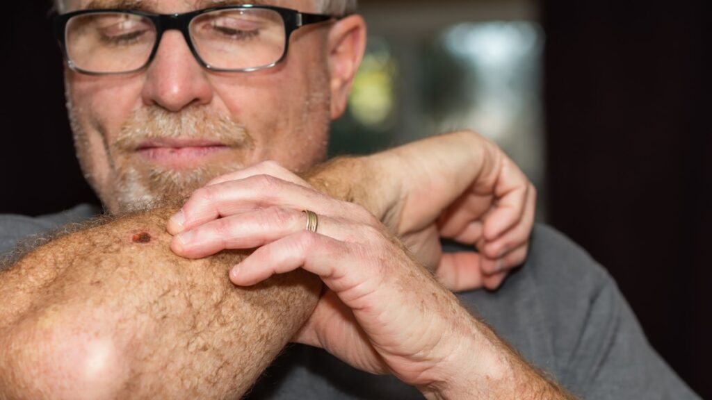 Man looking at mole on arm