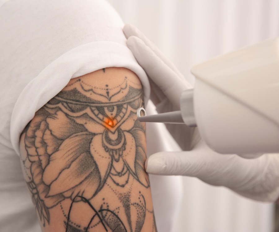 Rethink Your Ink With Laser Tattoo Removal - img1