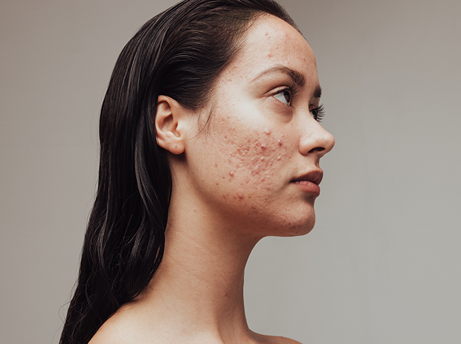 Acne - Core Dermatology