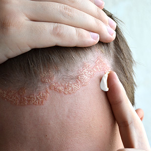 Psoriasis_3