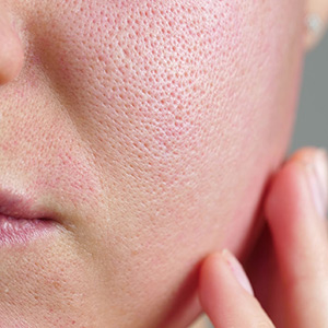 Rosacea