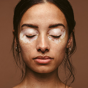 Vitiligo