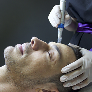 microneedling