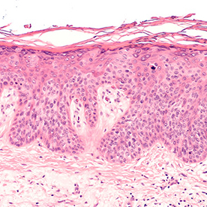 Skin-Cancer-Biopsy_sm