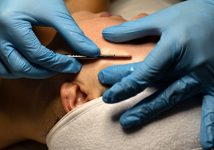 Dermaplaning